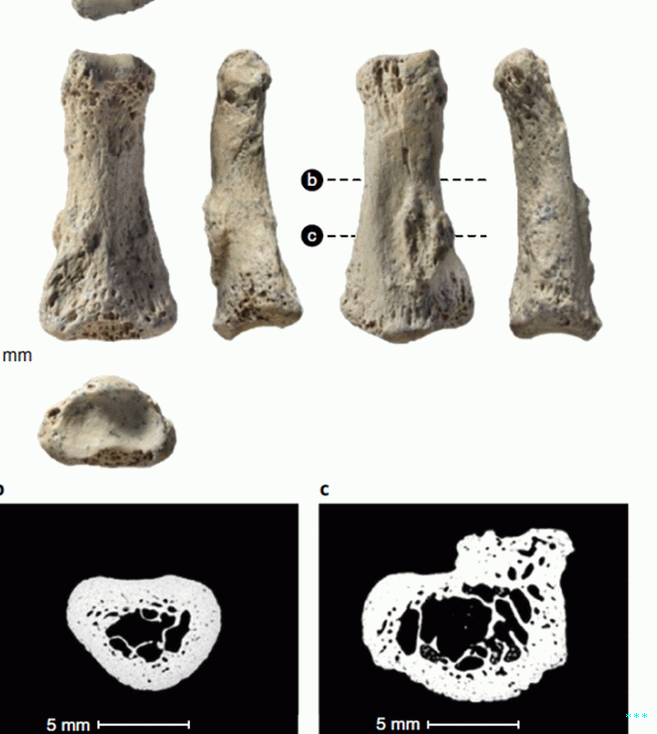 The enthesophyte is marked by "C" on the photos and CT scan الصور. 